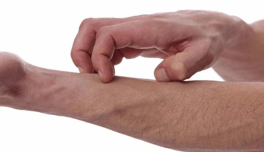 荨麻疹需要忌什么荨麻疹能自愈吗,麻疹处理流程