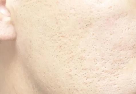 毛孔粗大收缩毛孔哪款爽肤产品好,毛孔粗大收缩毛孔最有效的产品