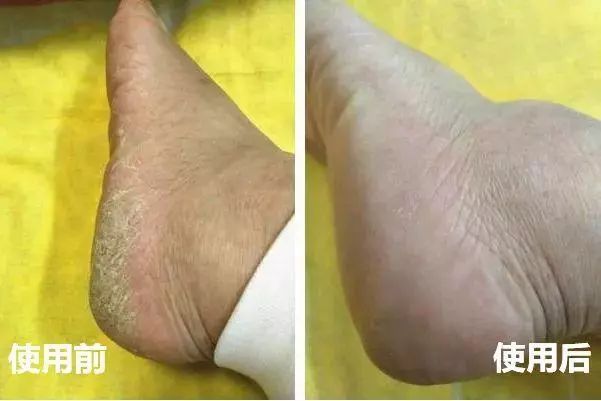 夏天了手脚干裂还有老茧,手脚干裂脱皮老茧用什么药膏