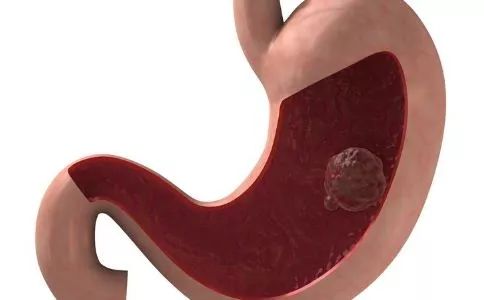 肠息肉胃息肉,肠息肉和胆囊息肉必须做手术吗