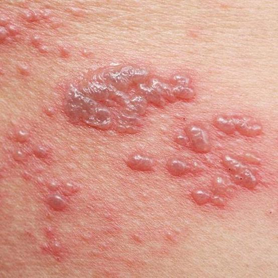 男性生殖器疱疹外用药物,男性感染生殖器疱疹的几率有哪些