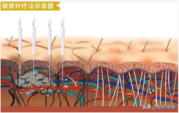 肩不举,肩周炎严重手抬不起最佳治疗办法