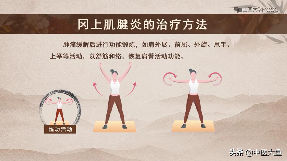 冈上肌腱炎的体征,冈上肌肌腱炎的症状及治疗