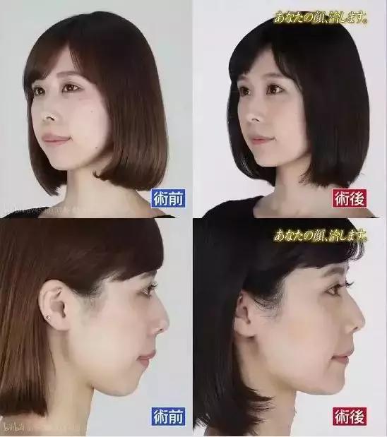 日本整容真的亚洲最好吗?流水线or独家定制,带你看日本整容业