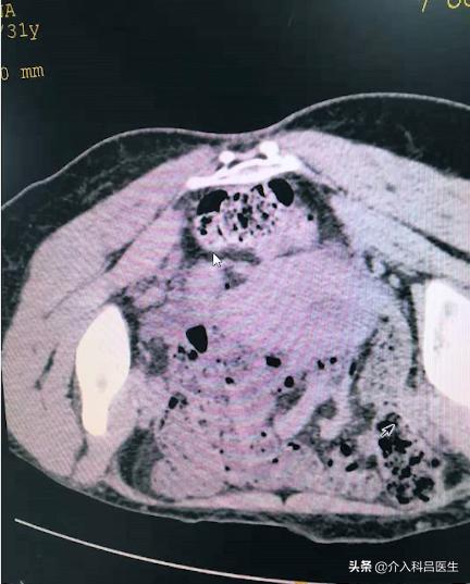 巧克力囊肿保守治疗方法是什么呢,巧克力囊肿如何彻底治愈