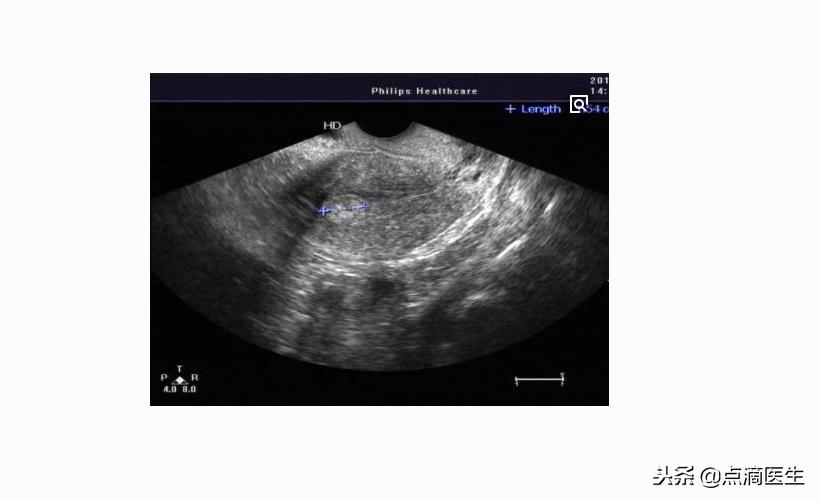 女性排卵不好能不能怀孕,如何判断自己是否正常排卵