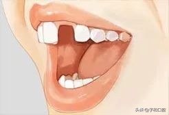 30秒看懂种植牙的全过程北大口腔,30秒看懂种植牙的全过程