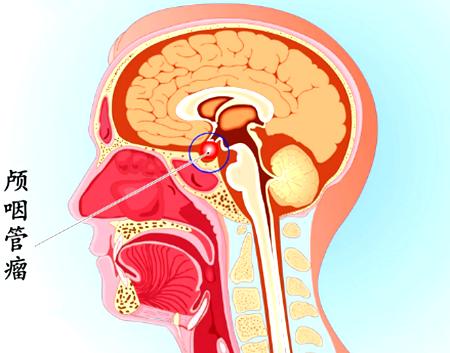 儿童颅咽管瘤术后尿崩的判定,颅咽管瘤术后尿崩夜尿会多吗