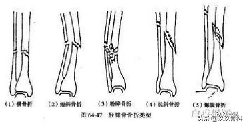 骨科术前术后注意事项,骨科手术体位安置标准流程
