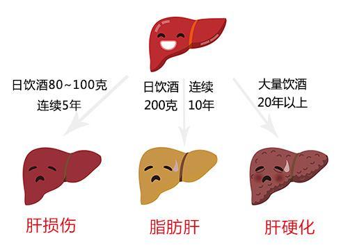 酒精性肝病的定义及发病机制,酒精性肝病和酒精性肝硬化