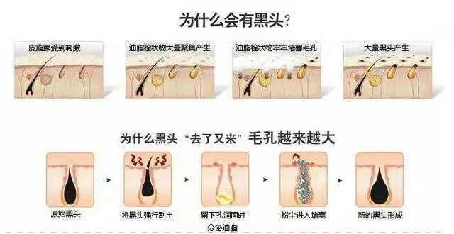 怎么解决糟心的黑头,怎么才能看清楚自己脸上的黑头