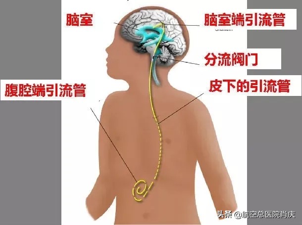 创伤性脑积水的最佳治疗方法,中医能治疗外伤性脑积水吗
