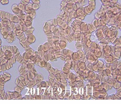 血液粘稠的病因及治疗,健康血液粘稠别小看但也别乱治
