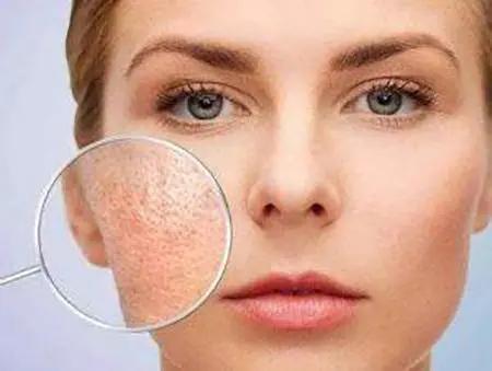 冬天螨虫多还是夏天螨虫多,怎么有效的去除螨虫简单方法