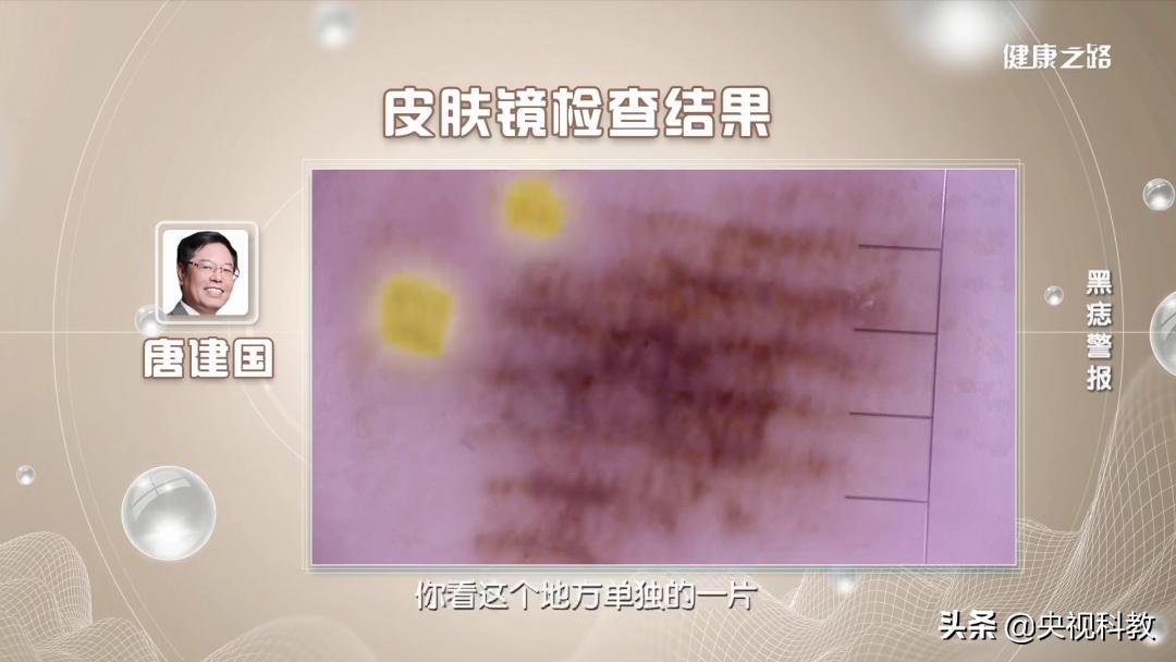 身上的黑痣有癌变的风险吗,身上长黑痣怎样防止恶变
