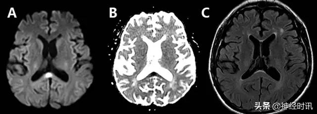 脑卒中病历诊断书图片,脑卒中影像判断技巧图解电子版
