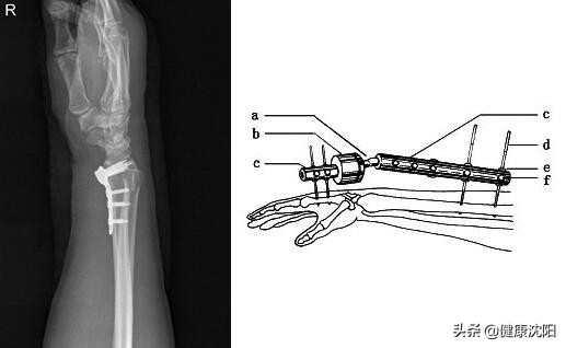 健康科普知识常见骨折防御知识,桡骨远端骨折健康宣教科普知识