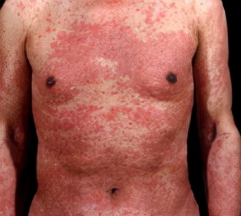 接触性皮炎怎么治最快,接触性皮炎怎么治能除根