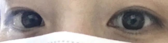 到底该不该全切双眼皮,怎么判断自己该不该割双眼皮