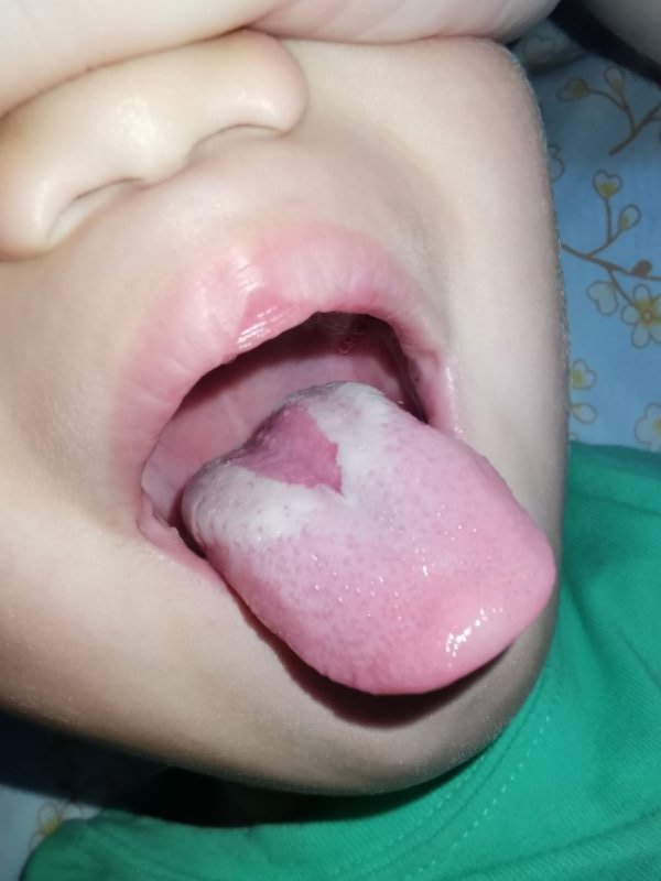 舌痛红无苔吃什么药,舌头上的舌苔怎样判断身体状况