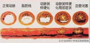 腿梗严重吗,为什么有的人脑梗心梗腿很正常