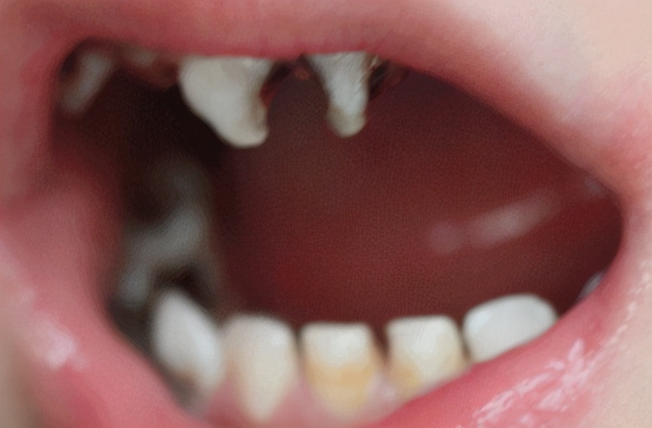 乳牙龋病是否需要治疗,乳牙龋病的预防