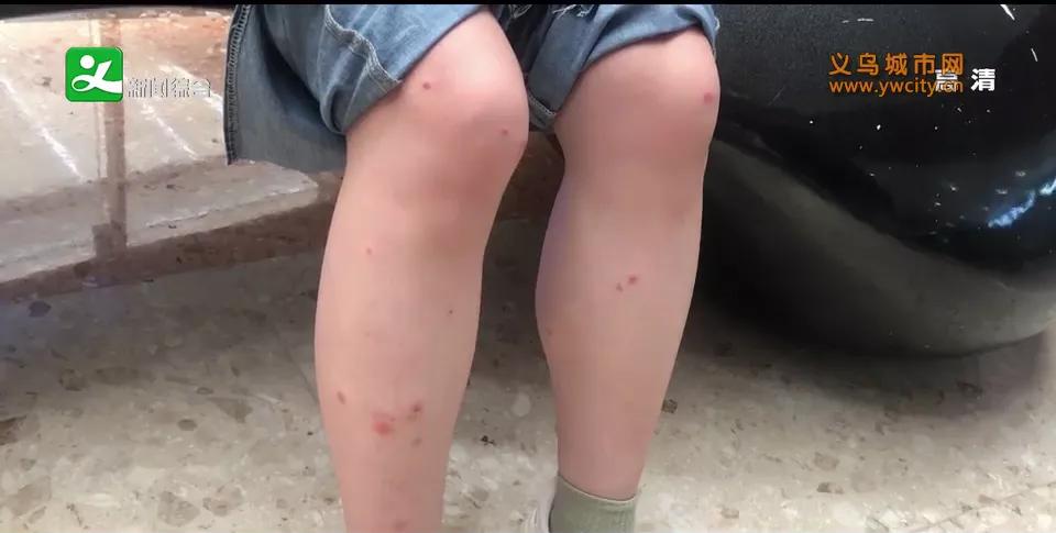 去了海边之后长了小红疹,去海边没暴露的地方起疹子