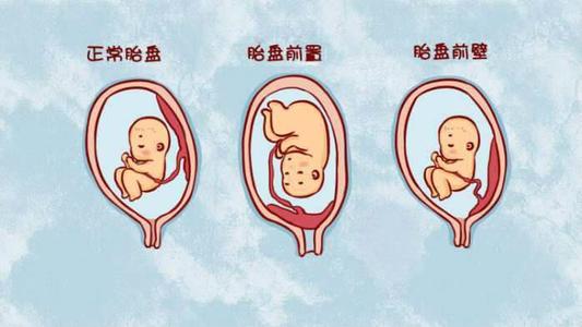 孕中期胎盘前置状态容易长上去吗,胎盘前置孕中期有什么征兆吗