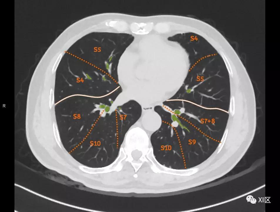 如此详细的肺部影像解剖，有点儿酷