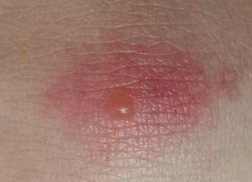 被蚊子咬了怎么办最有效的方法,被蚊子咬了怎么有快速的解决方法