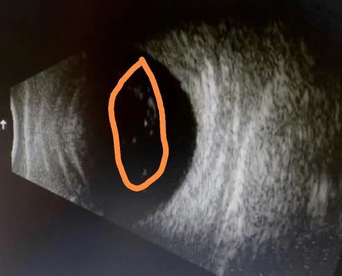 眼前有黑点飞蚊症,眼前有飞蚊症是怎么回事