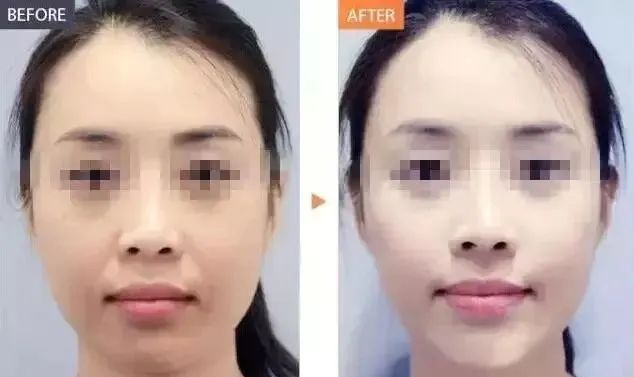 果酸可以根治闭口吗,果酸去闭口可以天天用吗