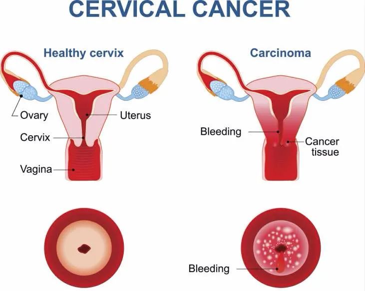 宫颈癌前病变变癌几率,宫颈癌的前兆最明显有什么表现