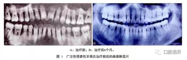 激光在口腔中的适应症,激光种植牙是什么意思