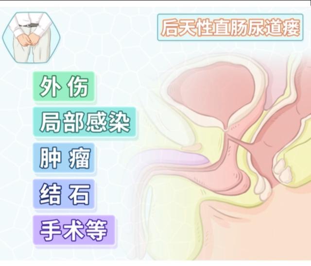 膀胱直肠瘘是什么病,直肠尿道瘘是直肠癌的症状吗