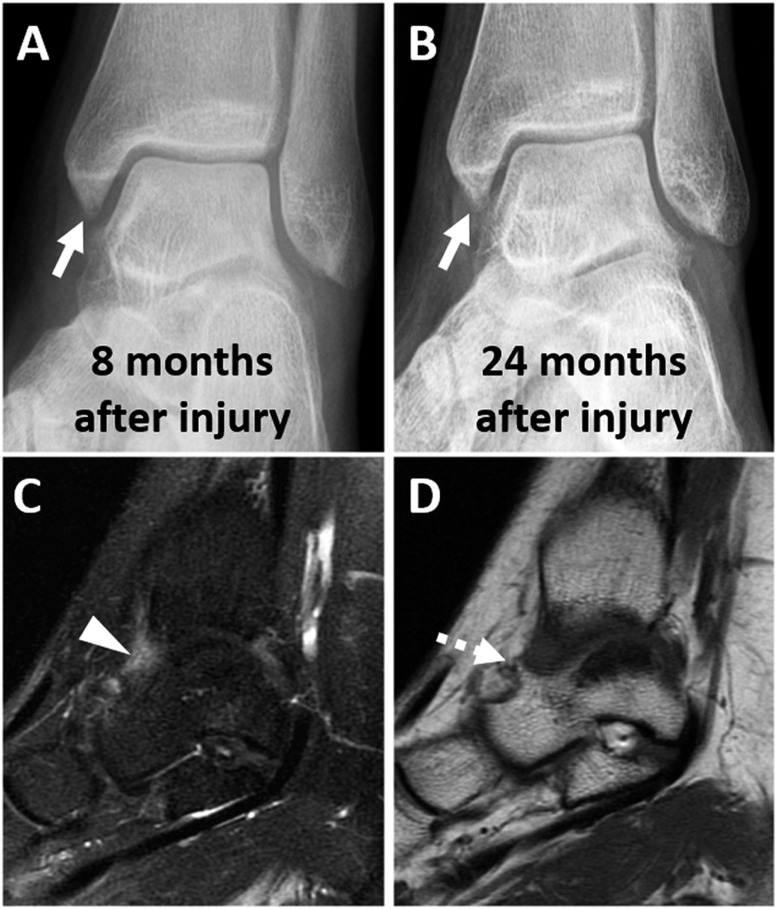 内旋踝关节出现前内侧疼痛应该警惕--前内侧撞击综合征