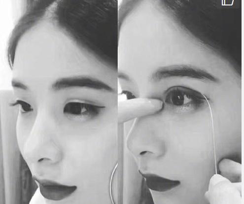 听说有眼袋又有泪沟怎么弄,眼下脂肪多就可以有卧蚕吗