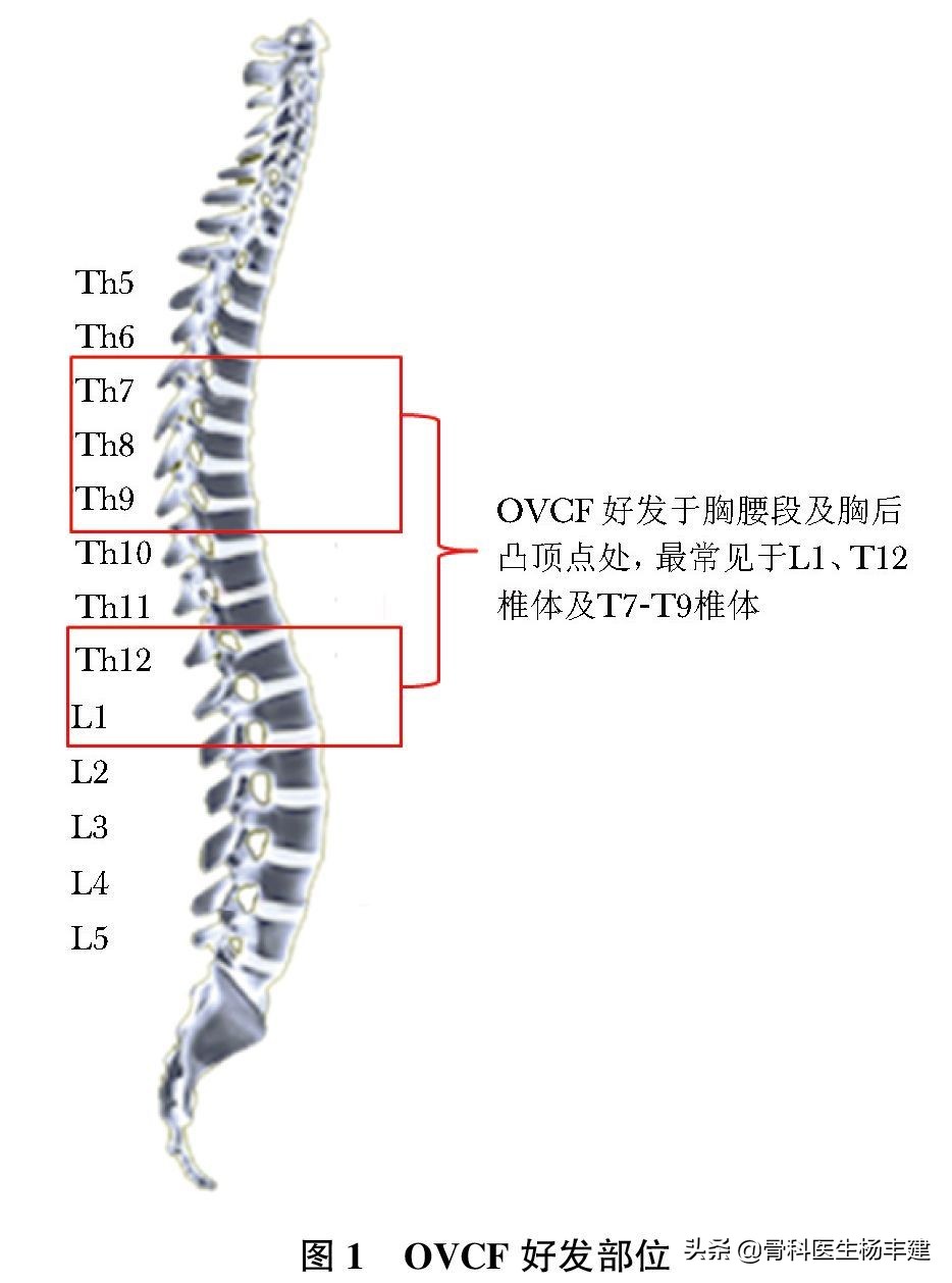 专家建议：老年人出现腰椎骨折，不一定需要做手术！