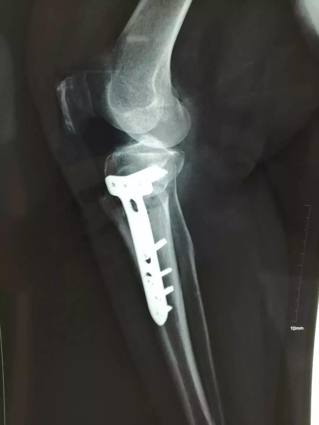 换膝盖关节手术有瘫痪风险吗,换膝手术可以百万医疗理赔吗