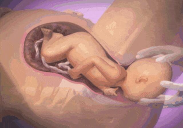 顺产可以无痛分娩吗,顺产还不疼能不能打催产针