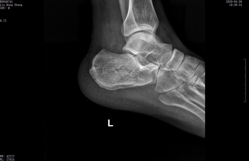 左股骨粗隆间粉碎性骨折微创手术,跟骨粉碎性骨折微创手术最快多久