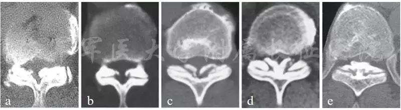 胸椎黄韧带骨化的治疗方法,胸椎黄韧带骨化症手术效果如何