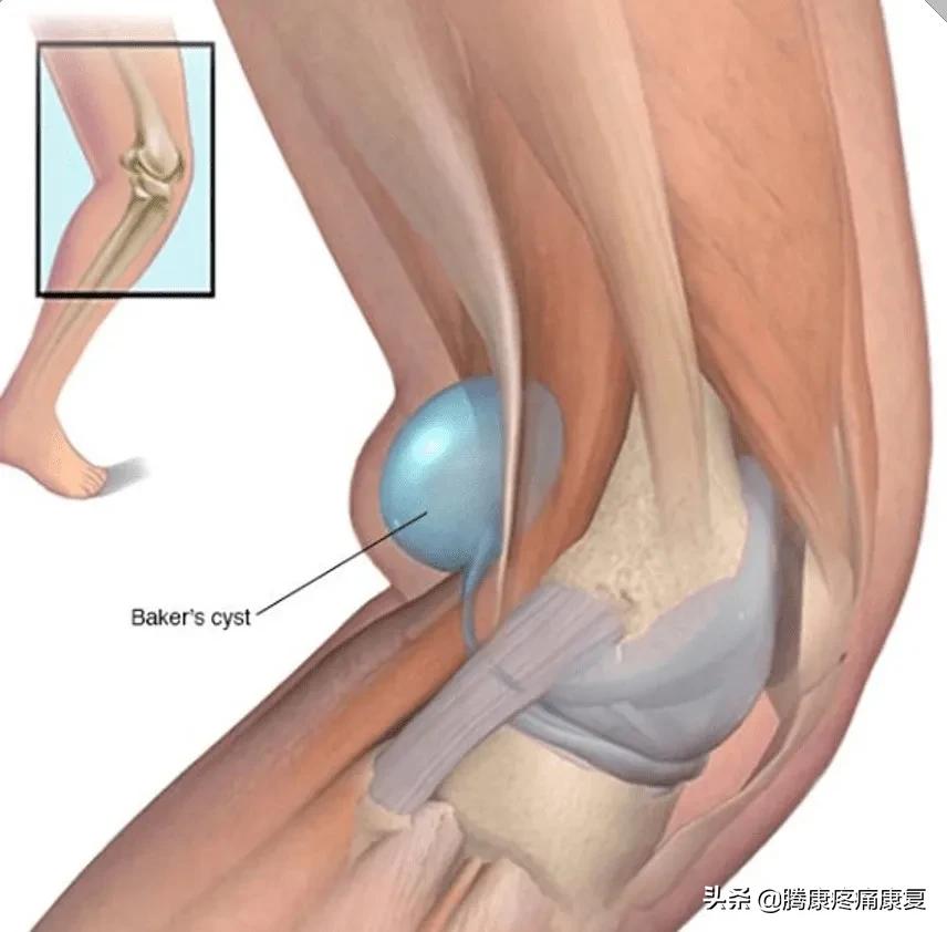 小腿疼痛的原因和治疗原则图片,脚小腿肌肉疼痛是什么原因