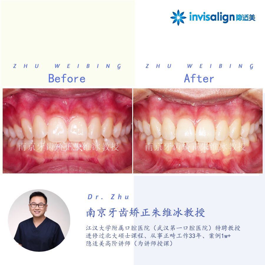 南京口腔医院矫正一颗牙齿多少钱,大医院为啥不建议做牙齿矫正