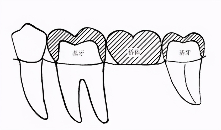 假牙为什么要叫做义齿,假牙为什么要换一个新牙