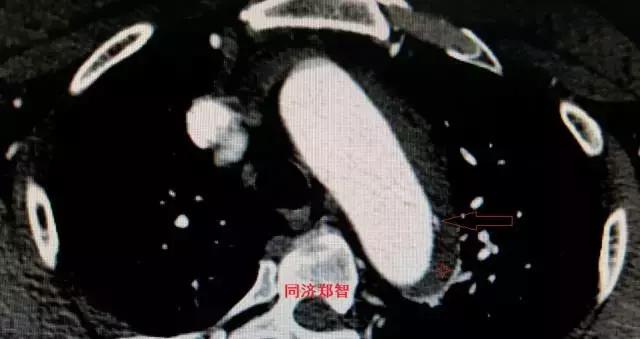 磁共振可以替代cta检查主动脉夹层,主动脉夹层cta上如何分辨真假腔