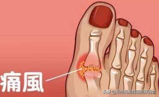 发现自己痛风后能根除吗,原阳哪里治疗痛风比较好