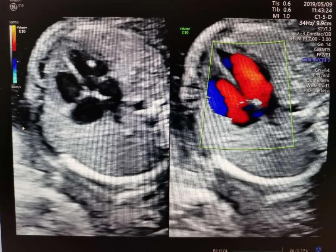 胎儿超声强回声,胎儿超声超细讲解视频