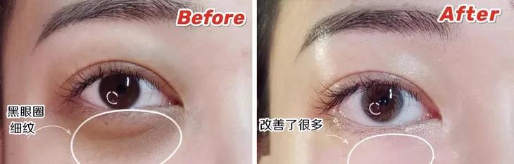 马应龙去除眼纹,马应龙去细纹