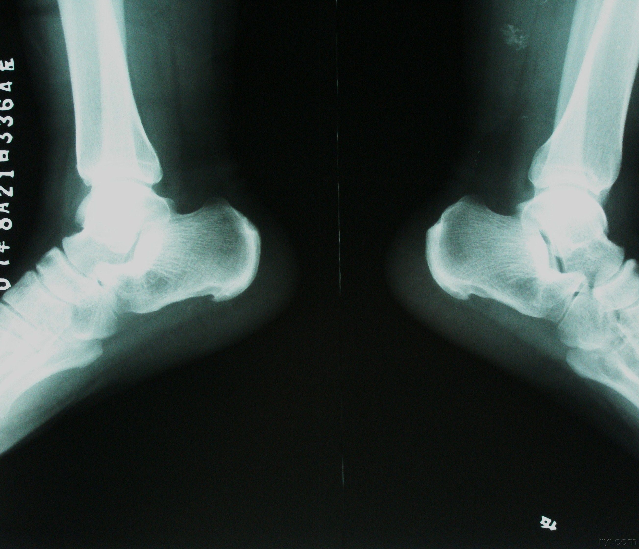 结节息肉囊肿增生哪个更容易癌变,结节囊肿增生息肉有什么区别